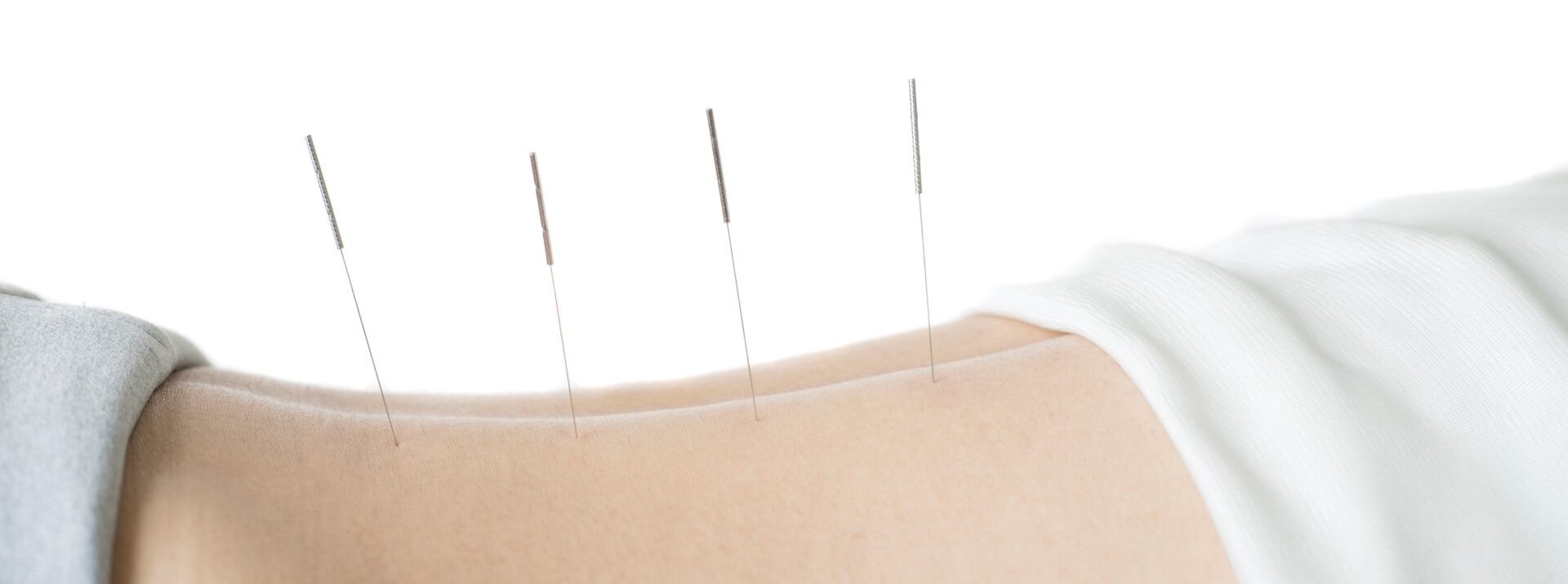 Experience the Balance and Wellness of Acupuncture